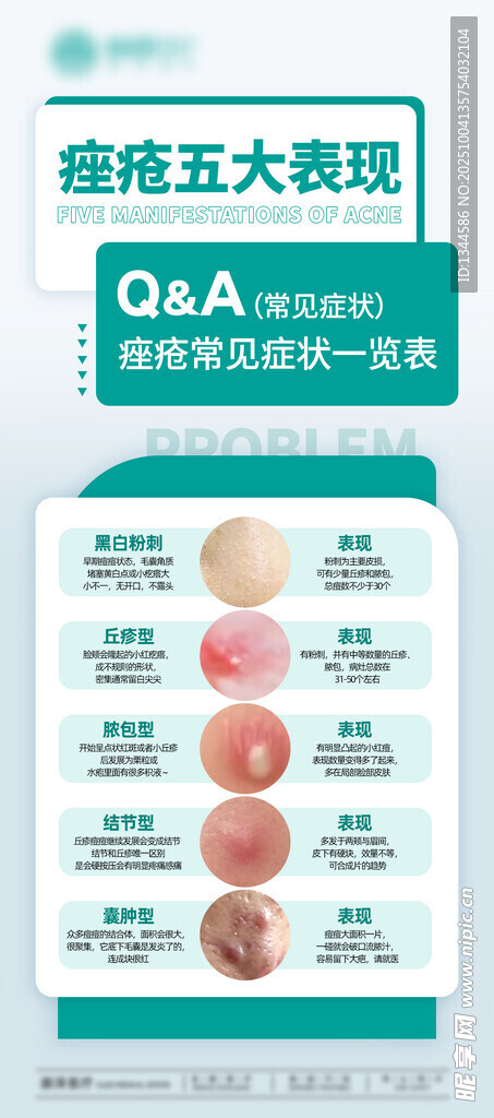 痤疮五大表现
