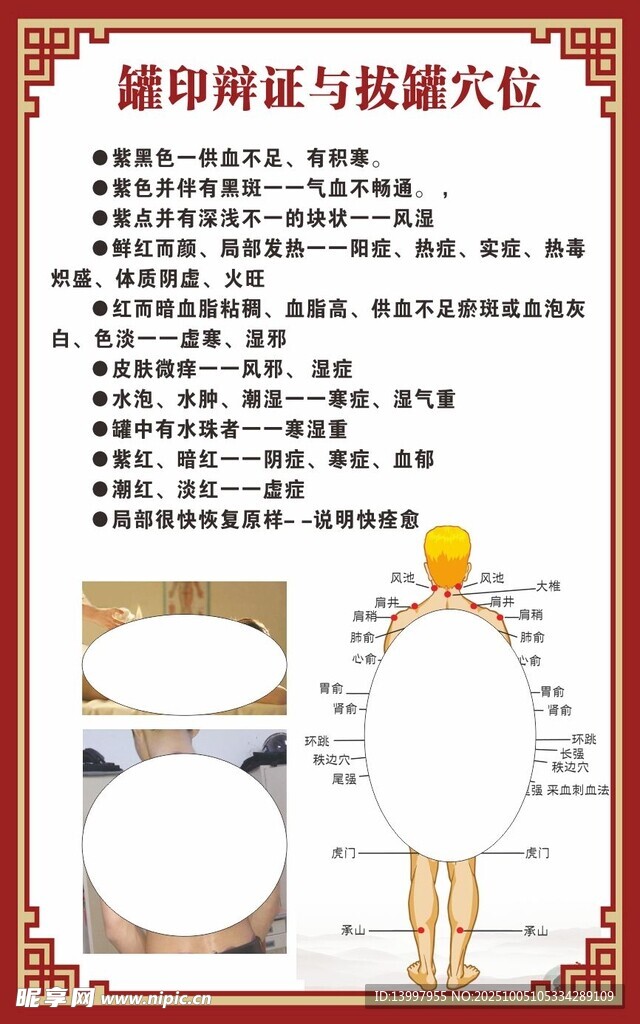 罐印辩证与拔罐穴位