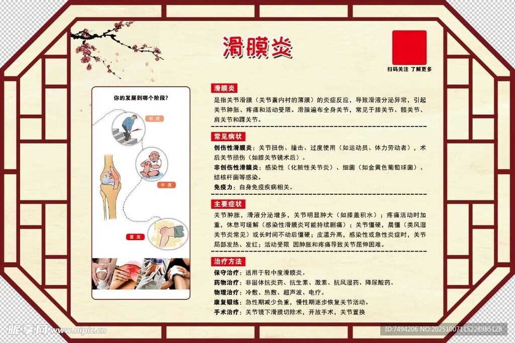 滑膜炎