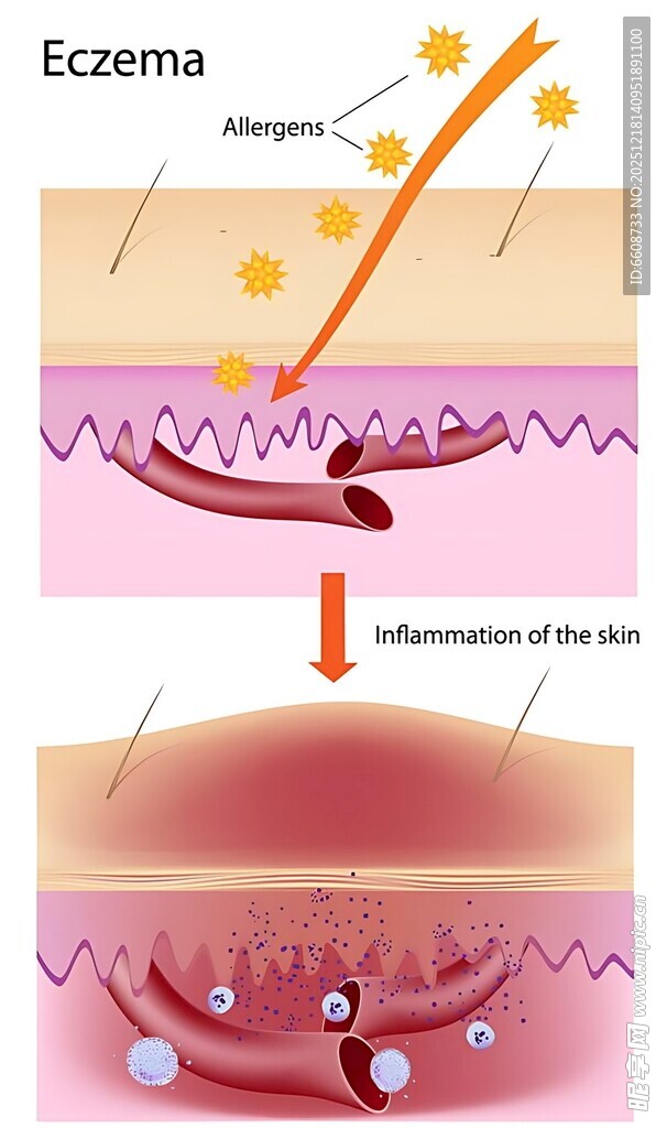皮肤湿疹结构示意图