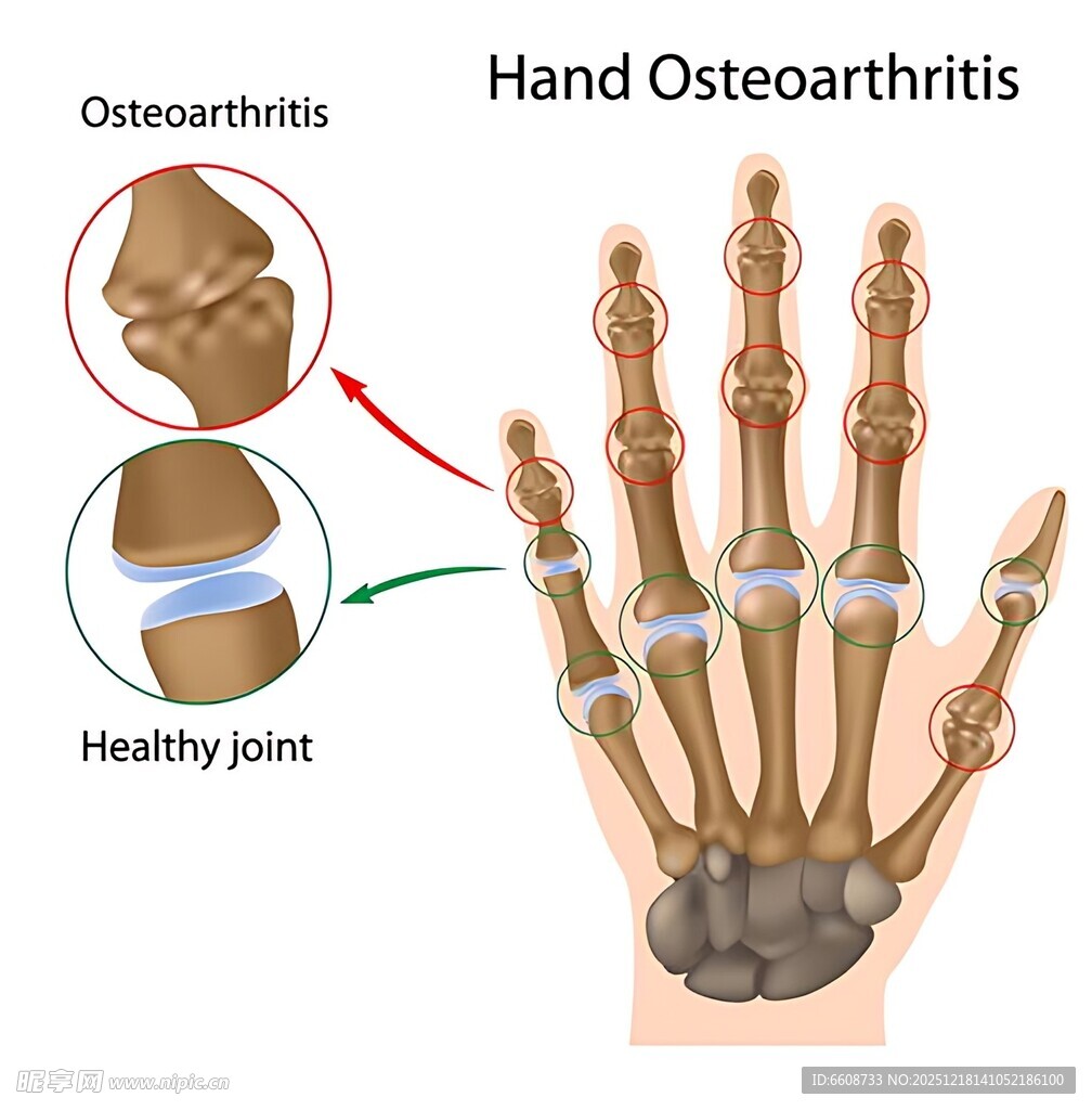 手部骨关节炎与健康关节对比
