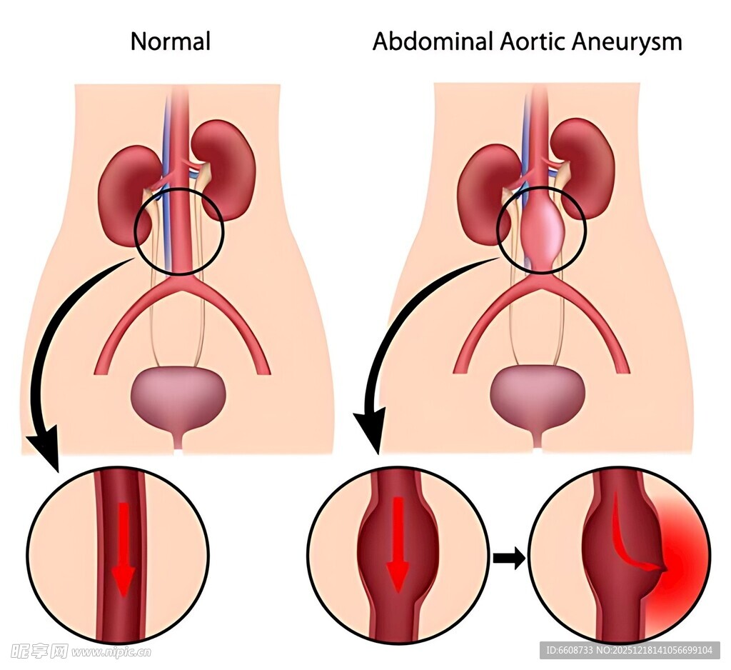 肾动脉解剖变异示意图