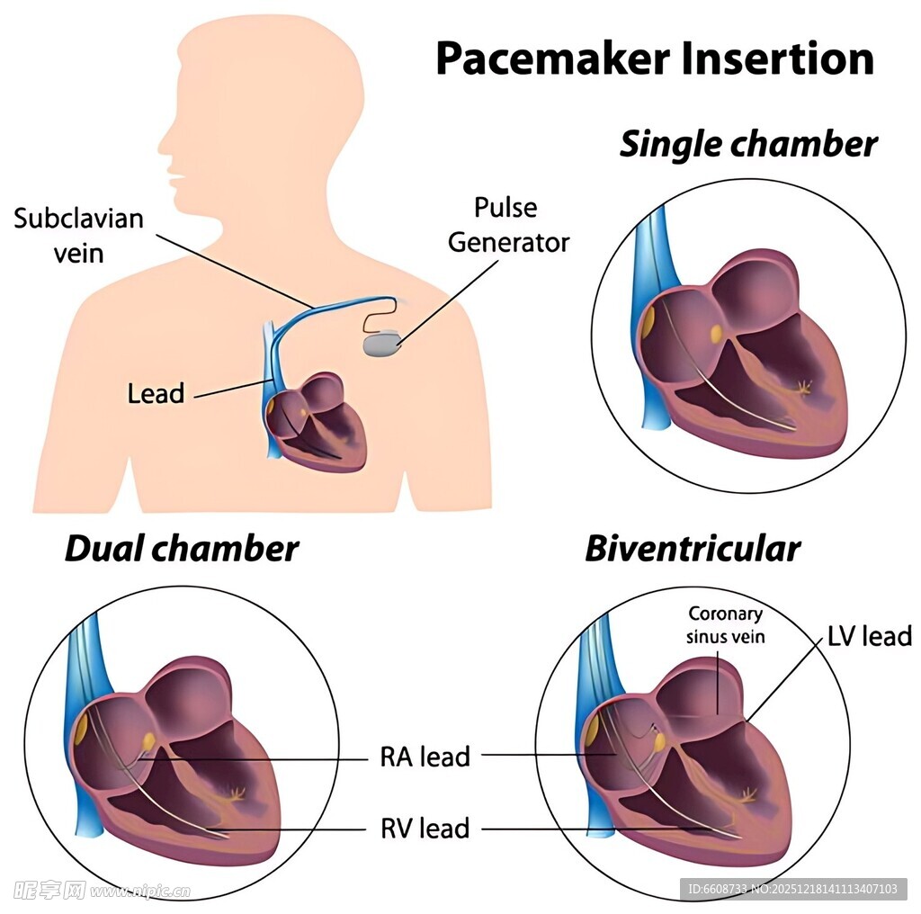 心脏起搏器植入示意图