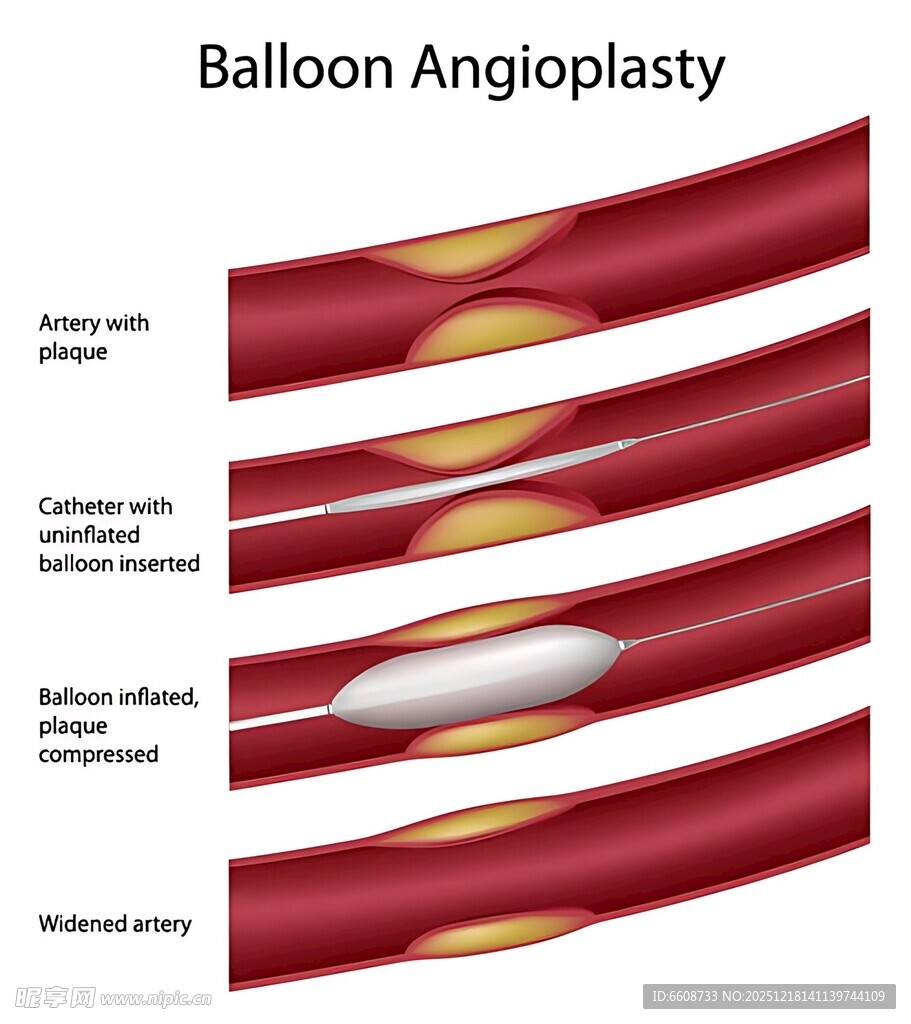 血管球囊成形术示意图