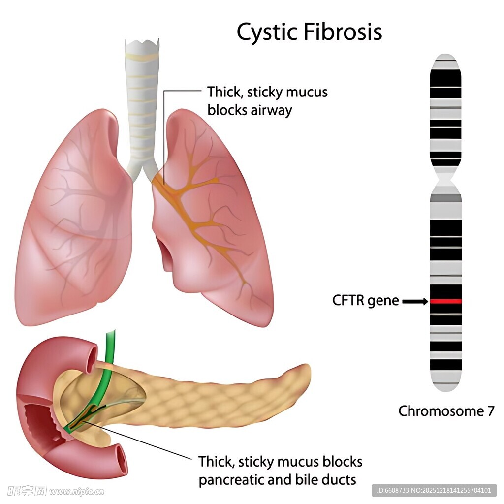 囊性纤维化疾病解剖示意图