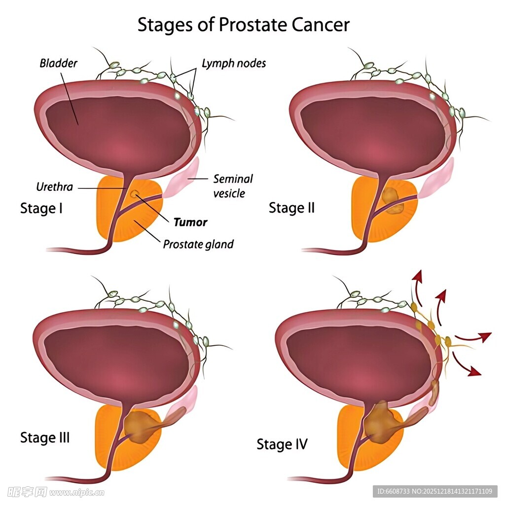 前列腺癌分期图示