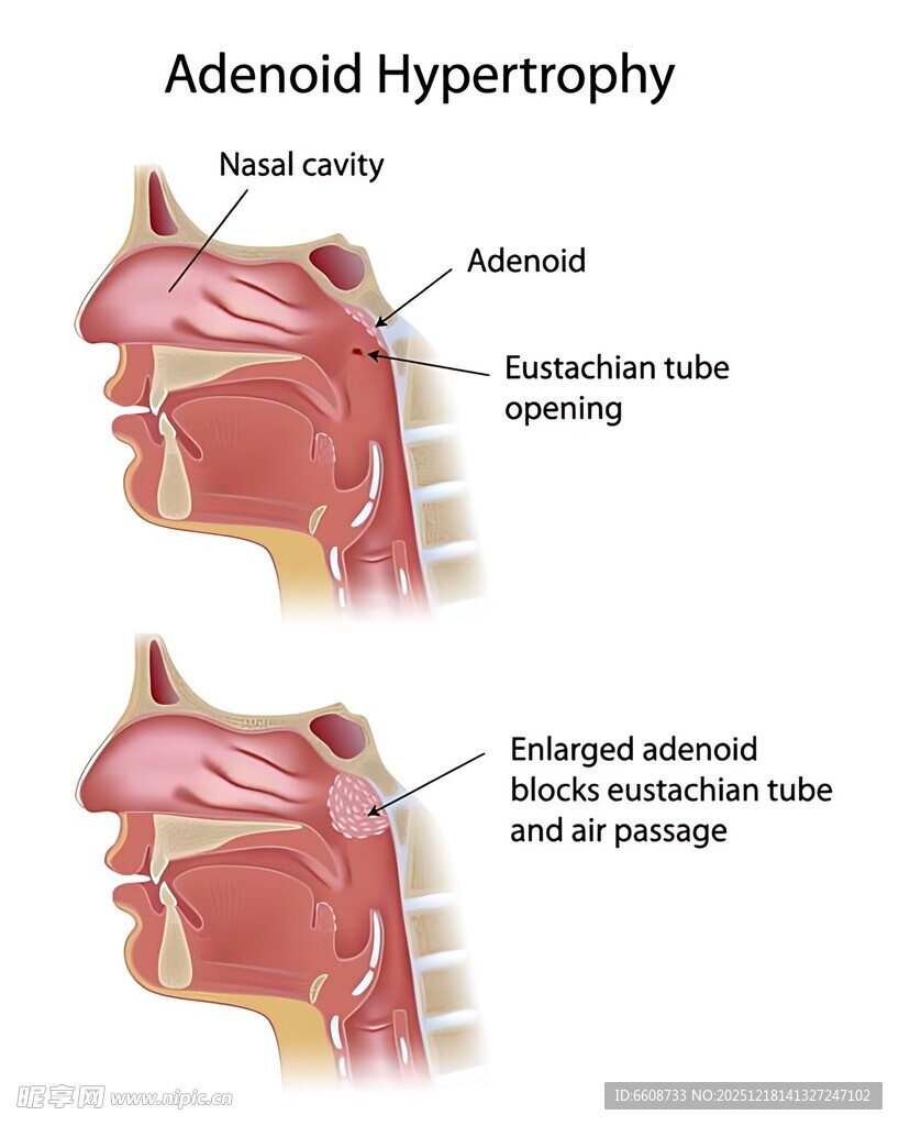 腺样体肥大解剖示意图