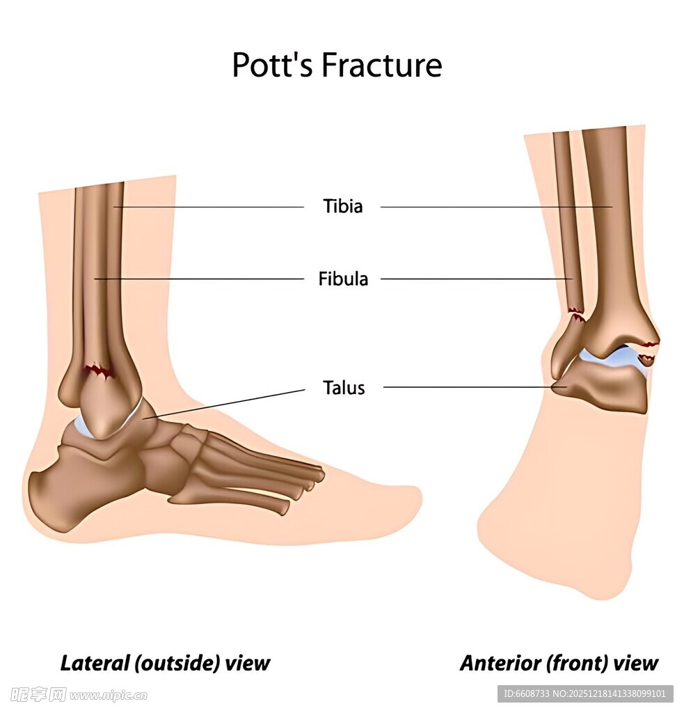 脚踝骨折部位解剖图