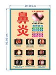 鼻炎治疗宣传海报