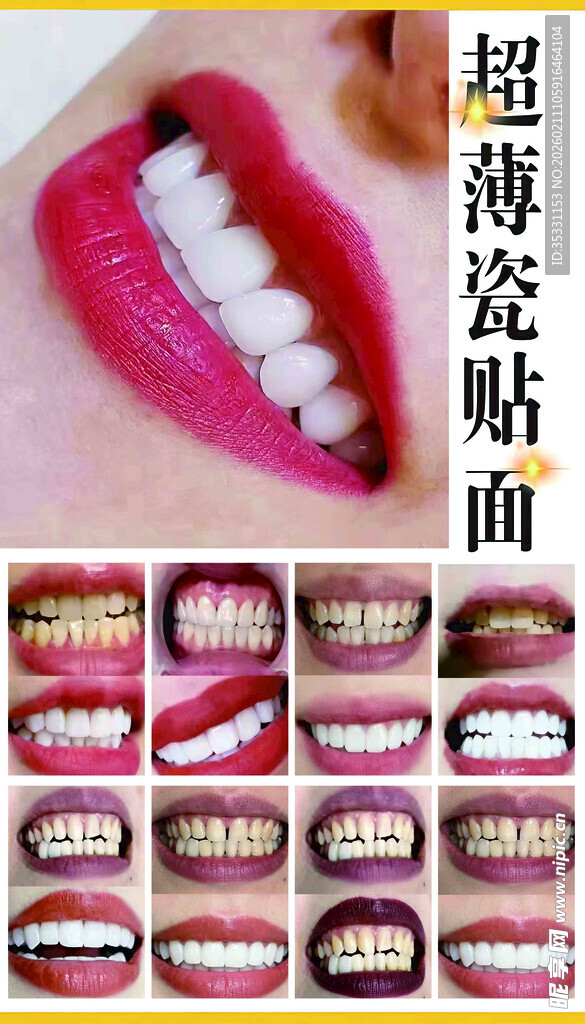 超萌陶瓷贴面展示