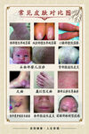 常见皮肤病对比图示