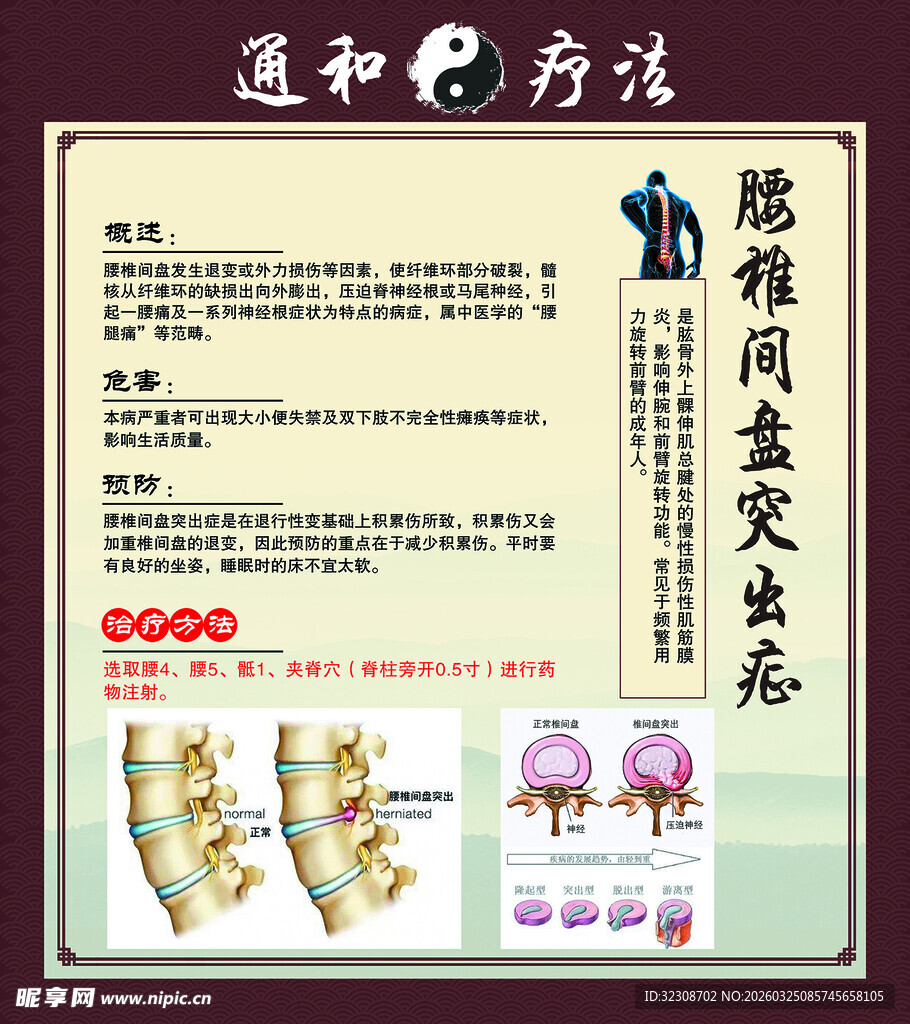 腰椎间盘突出症治疗科普