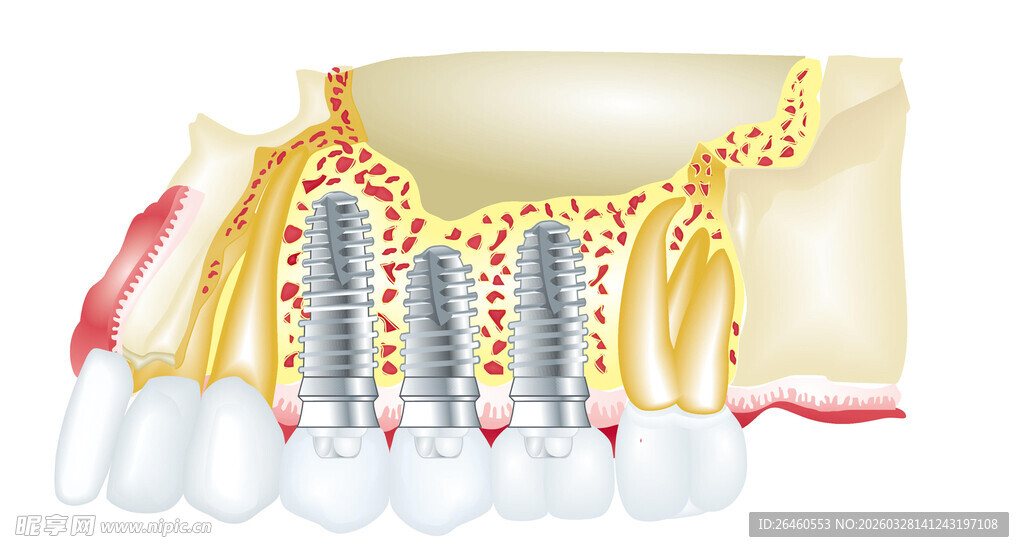 种植牙手术示意图