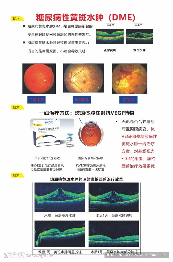 糖尿病性黄斑水肿
