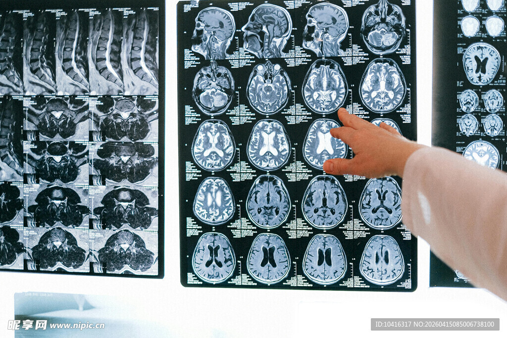 医生查看脑部CT影像