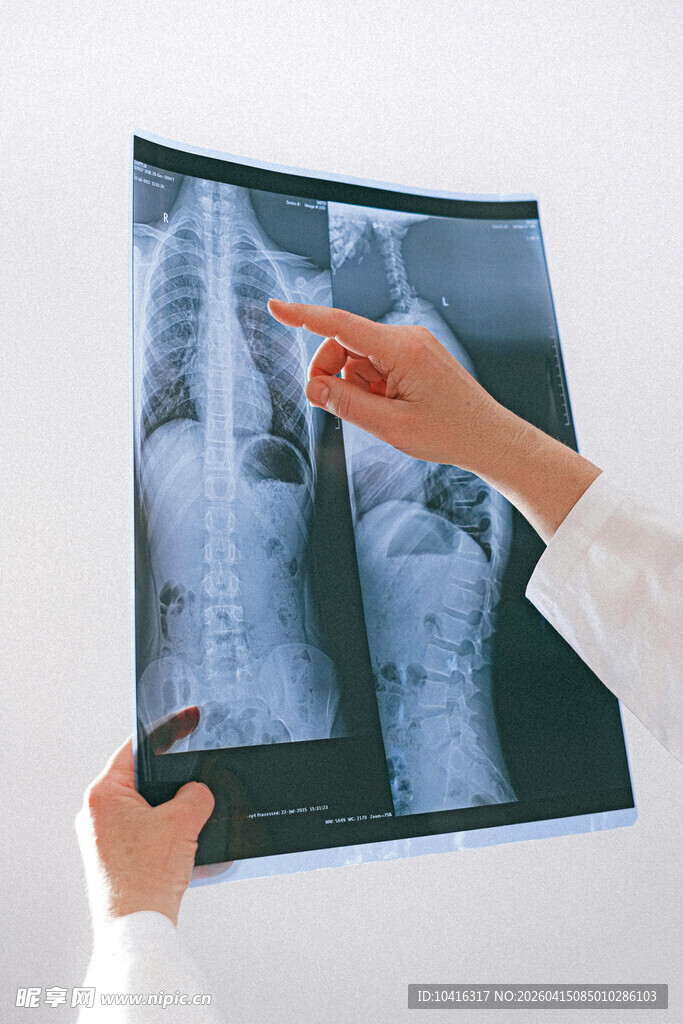 医生查看肺部X光片