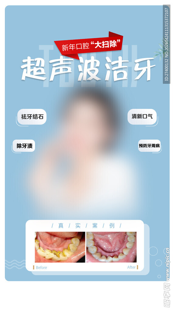 超声波洁牙宣传海报