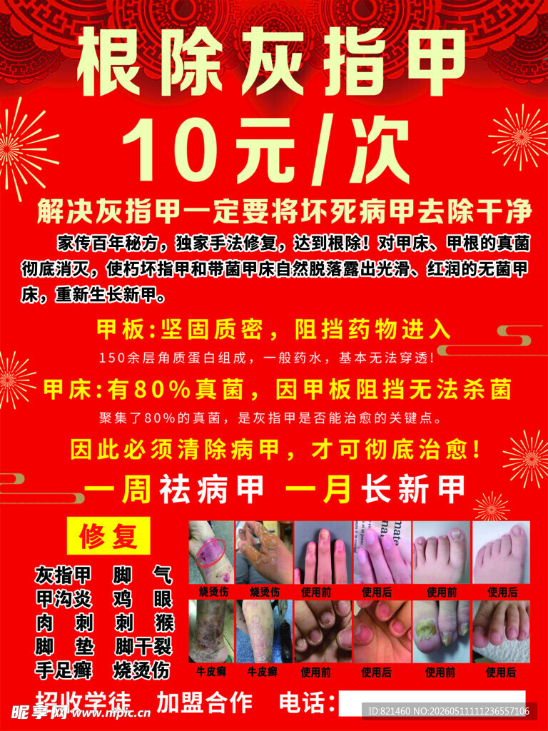 根除灰指甲10元优惠活动