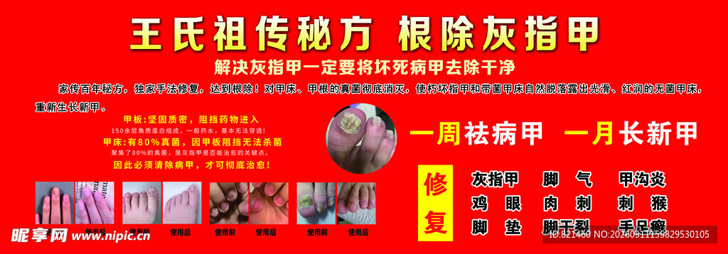 根除灰指甲去病甲