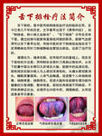 舌下取栓疗法简介