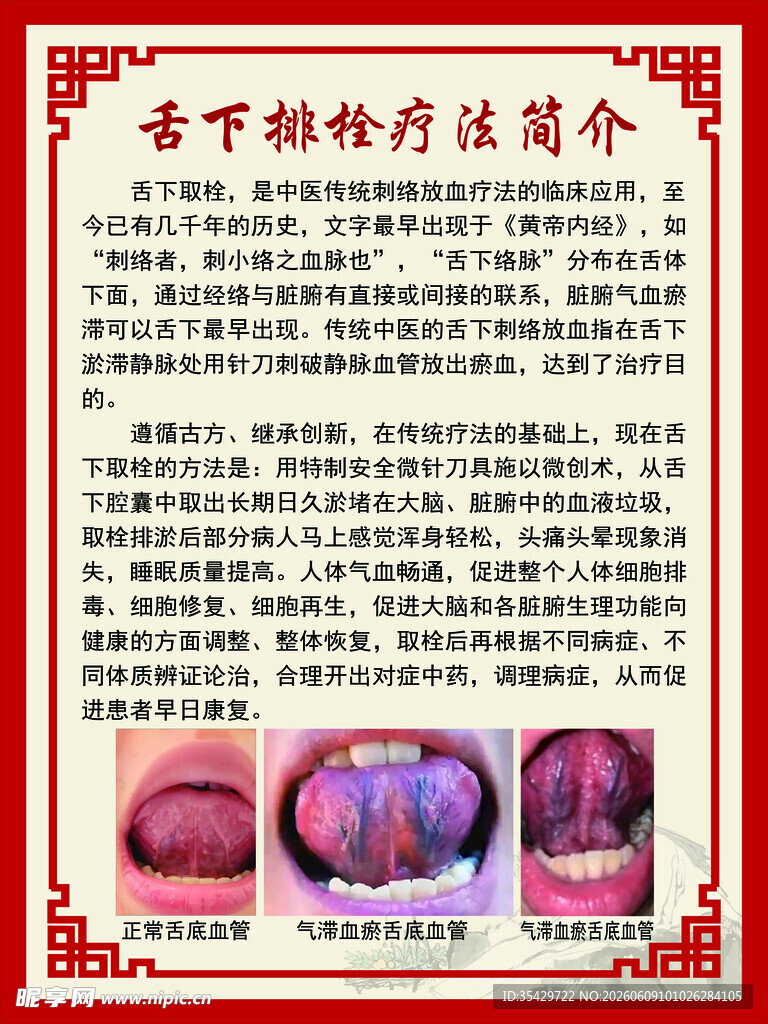舌下取栓疗法简介
