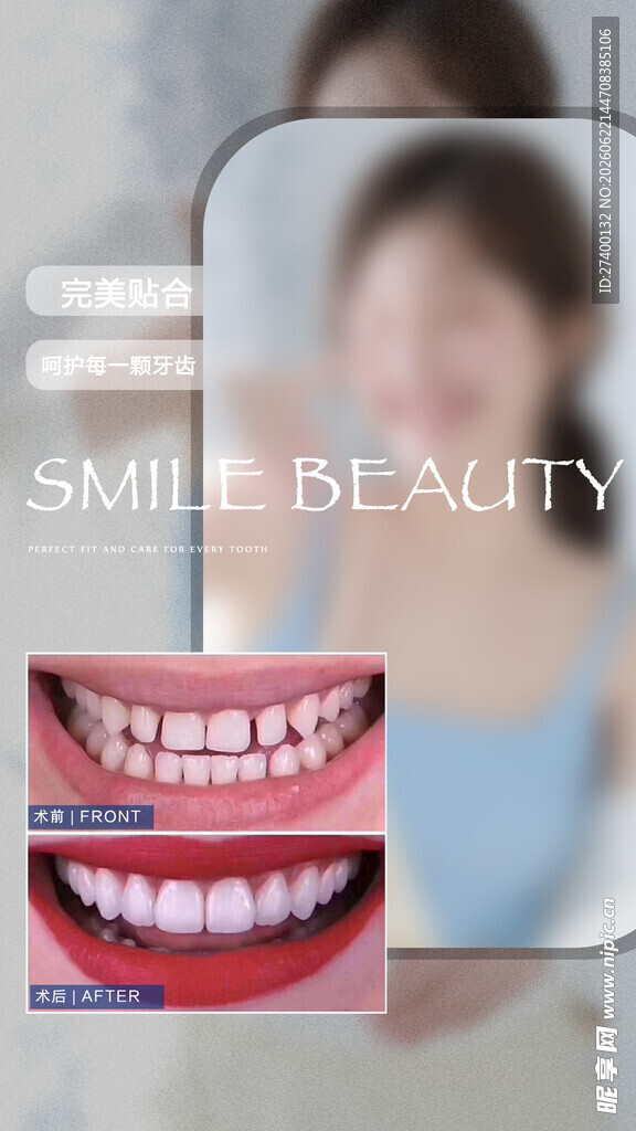 微笑美学牙套展示