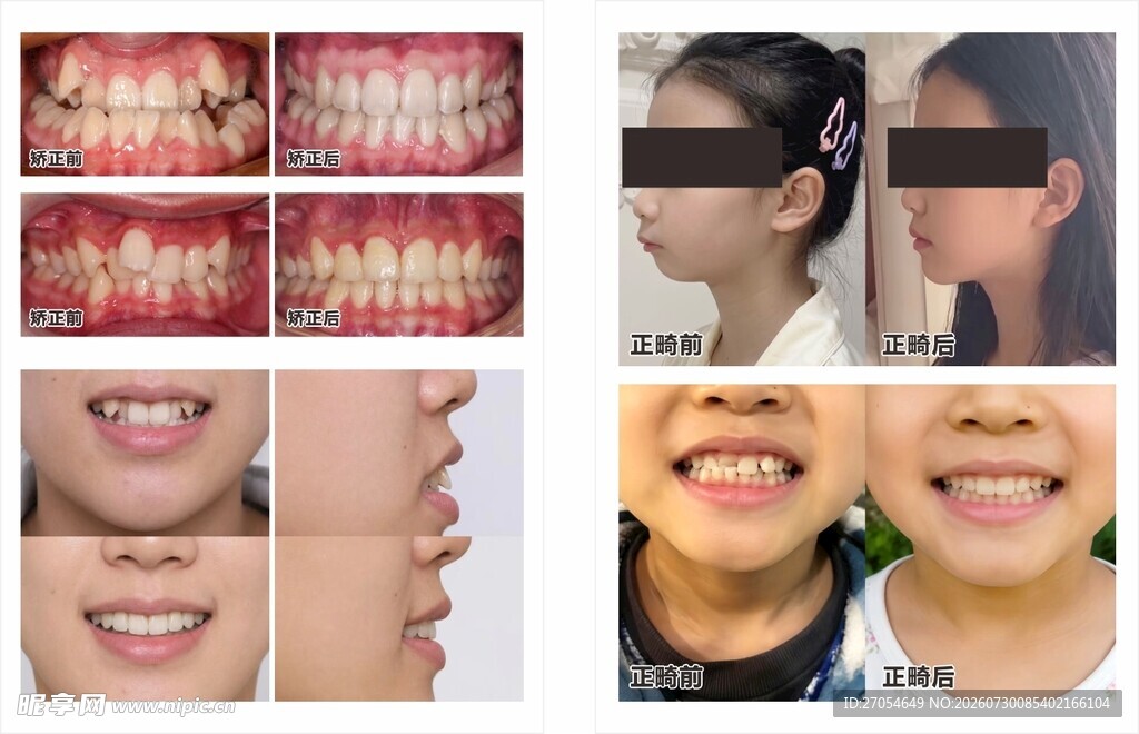 口腔正畸牙齿矫正前后对比图效果