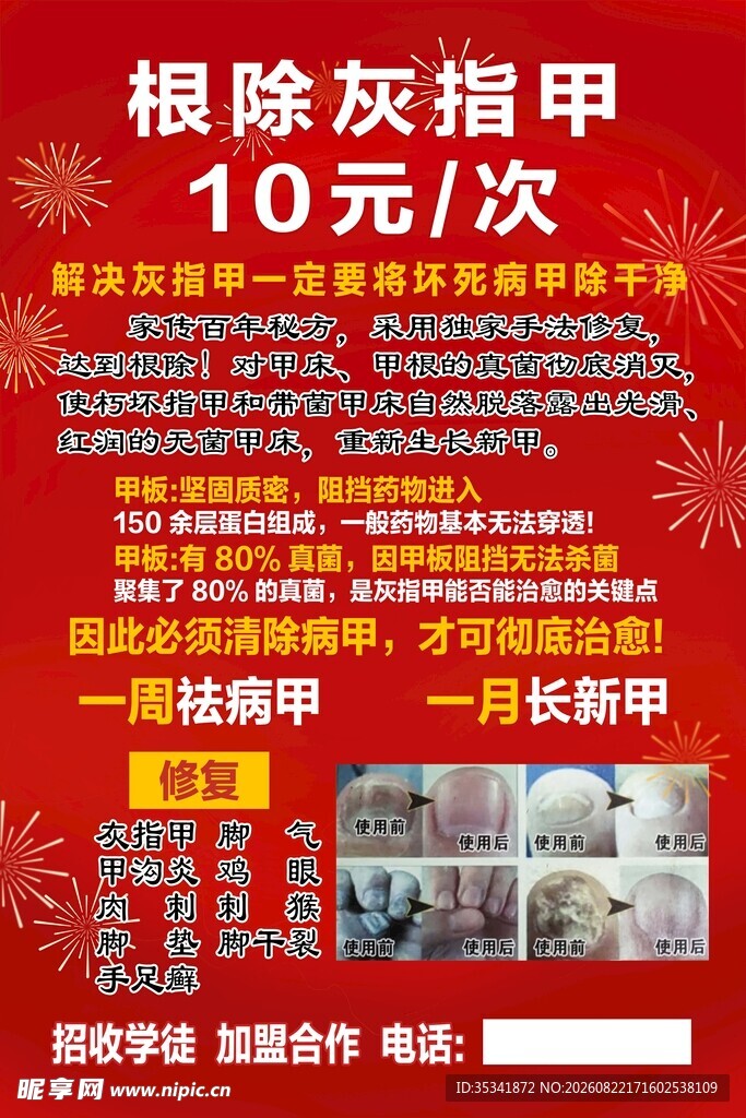 灰指甲宣传海报