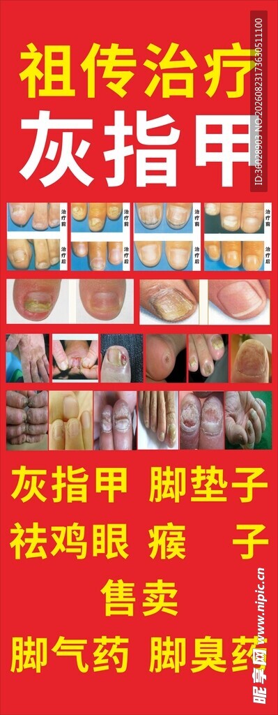 祖传灰指甲治疗现场
