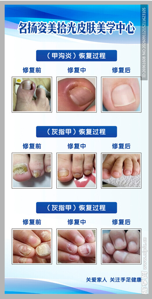 灰指甲