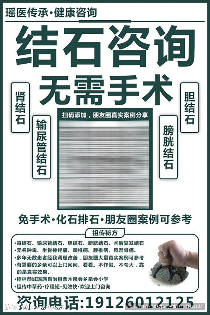 结石咨询与秘方
