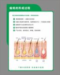 痤疮的形成过程
