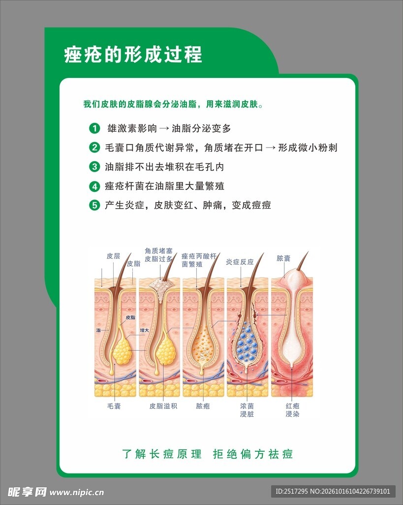 痤疮的形成过程