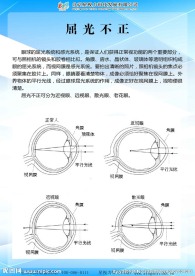 屈光不正