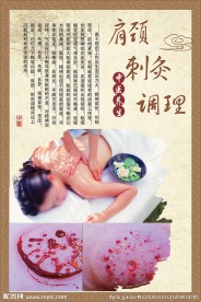 肩颈刺灸