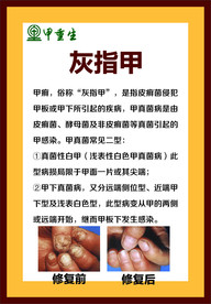 灰指甲海报