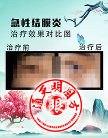 急性结膜炎
