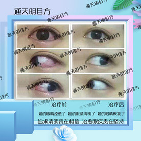 眼睛治愈前后对比