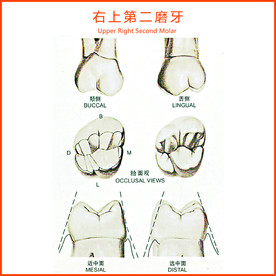 右上第二磨牙