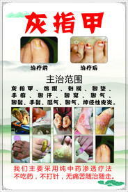 灰指甲 治疗范围