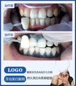 牙齿美白病例对比