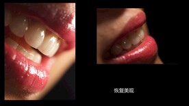 牙齿美学修复