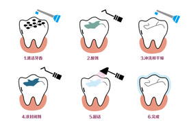 牙齿涂氟