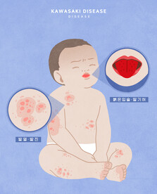 儿科手足口病  