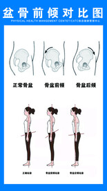 盆骨前倾对比图