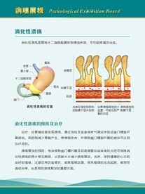 消化性溃疡