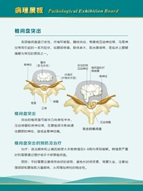 椎间盘突出