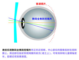 数码全焦防控镜片