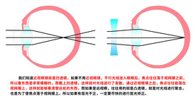 近视眼镜就是凹透镜