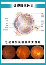 近视眼底改变